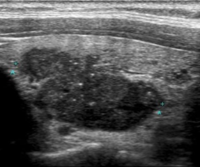 PAPİLLER TİP tiroid bezi kanseri